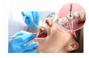 Root Canal Treatment in Hamilton