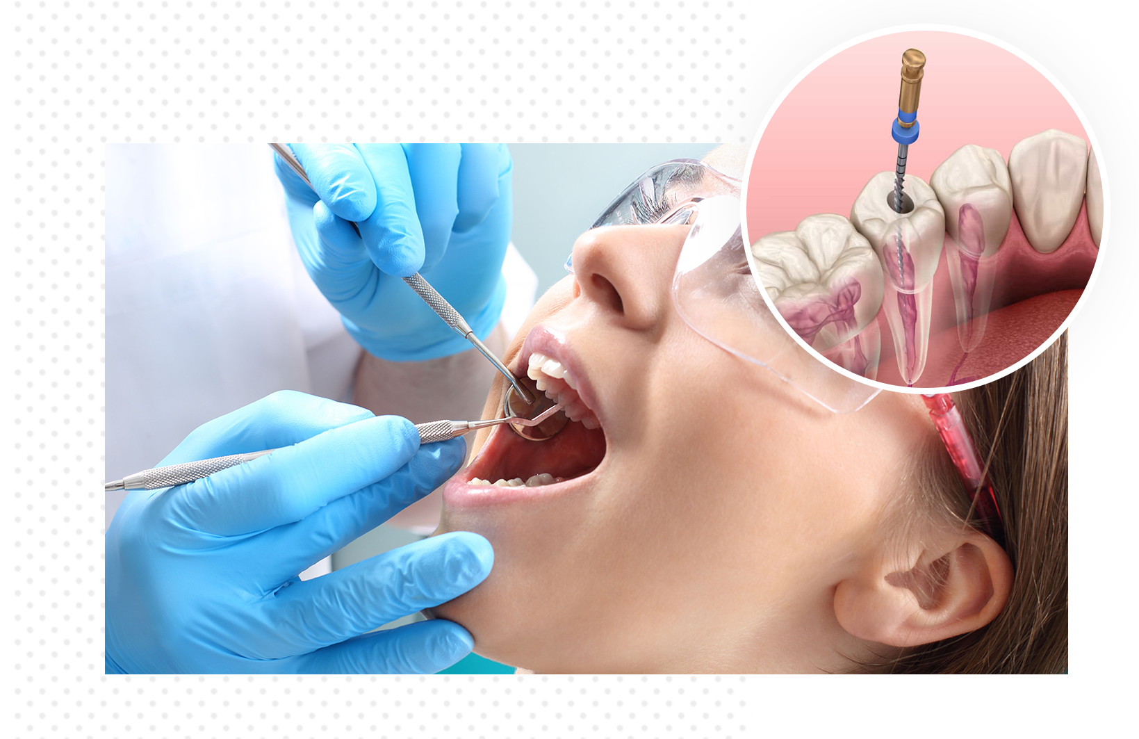 Featured image for “5 Effective Tips For Speedy Recovery After a Root Canal Therapy”