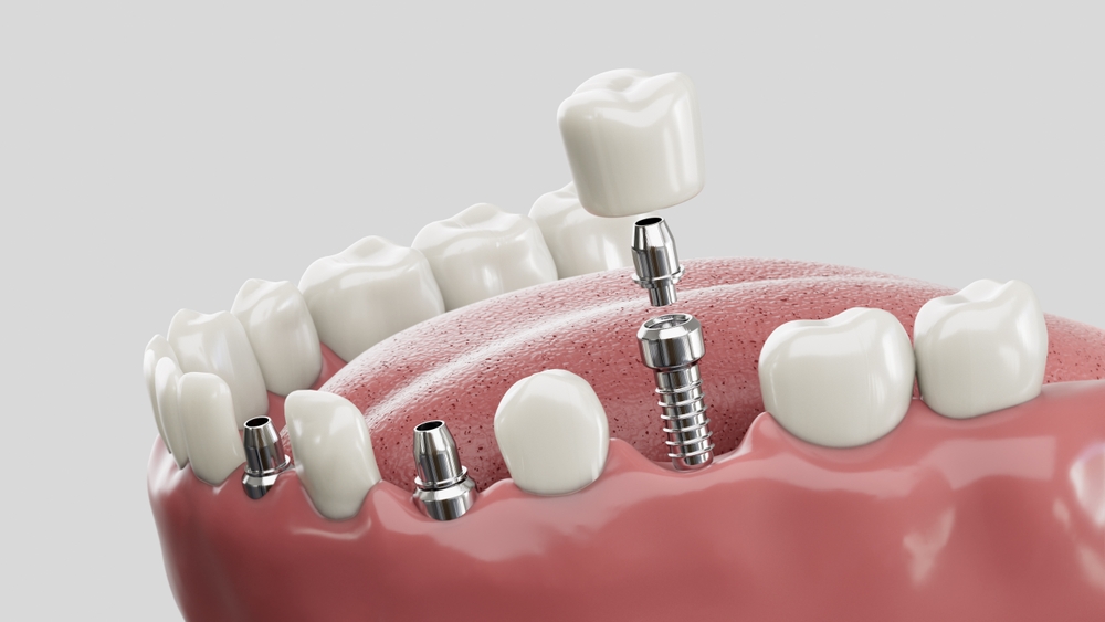 Featured image for “Dental Implants in Hamilton: Restore Confidence in Your Smile with Rosewood Dentistry”