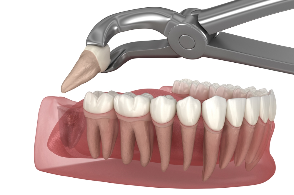 Dental crowns and bridges in Hamilton