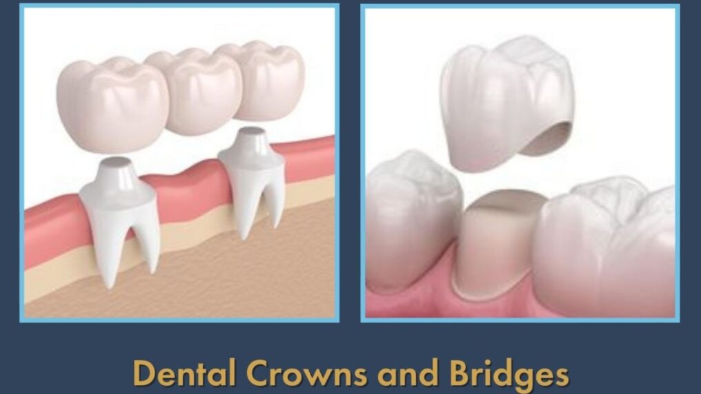 Dental crowns and bridges Hamilton ON