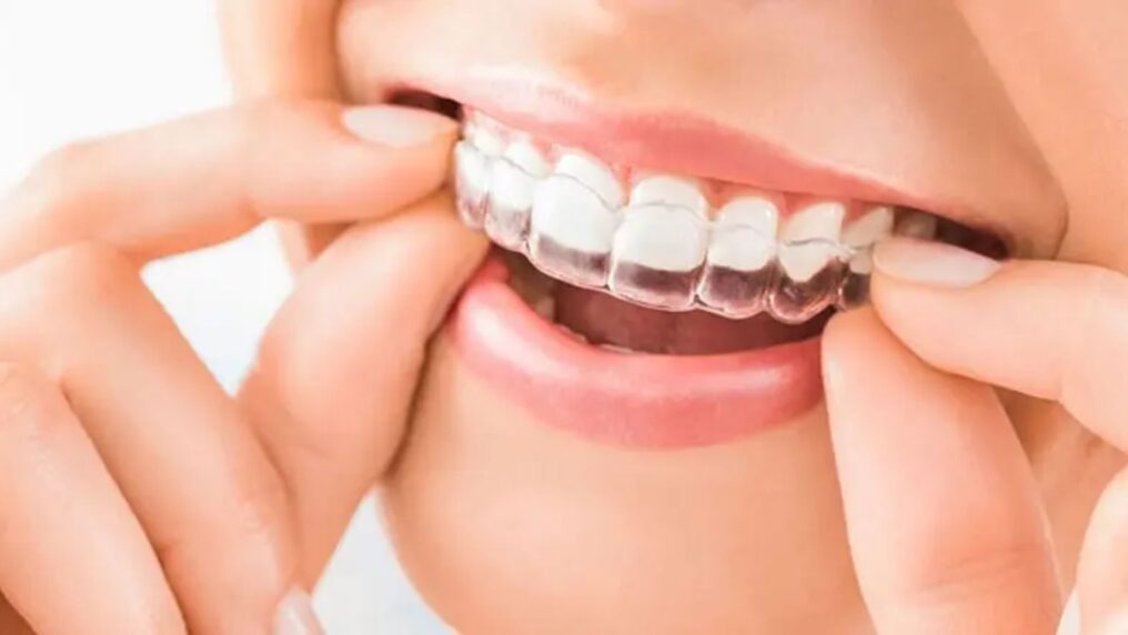 Invisalign aligners in Hamilton ON